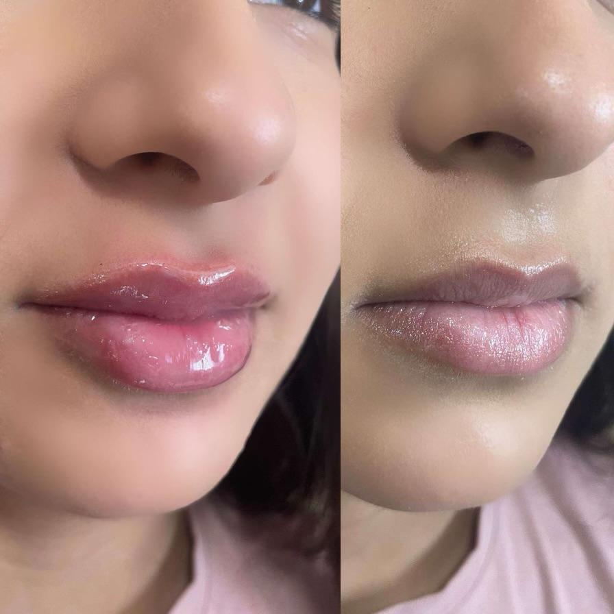  lip filler before and after