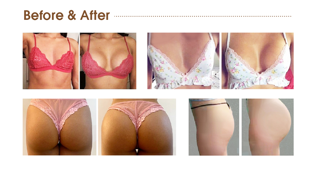 50ml butt filler for buttocks before and after photos