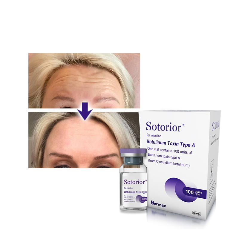 botulinum toxin for frown lines