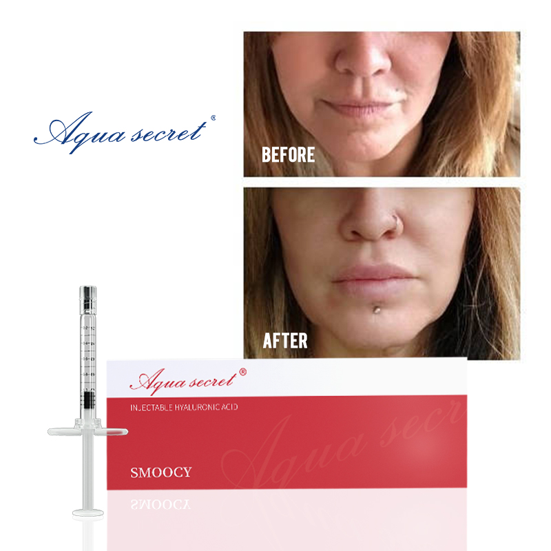 lip filler price range