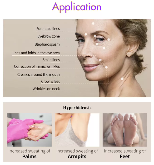  botulinum toxin treatment area