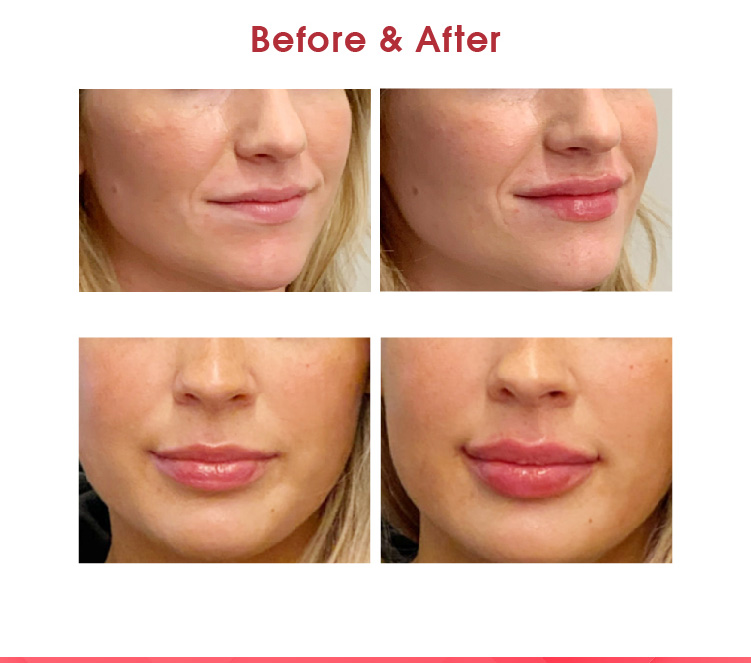 lip filler before and after