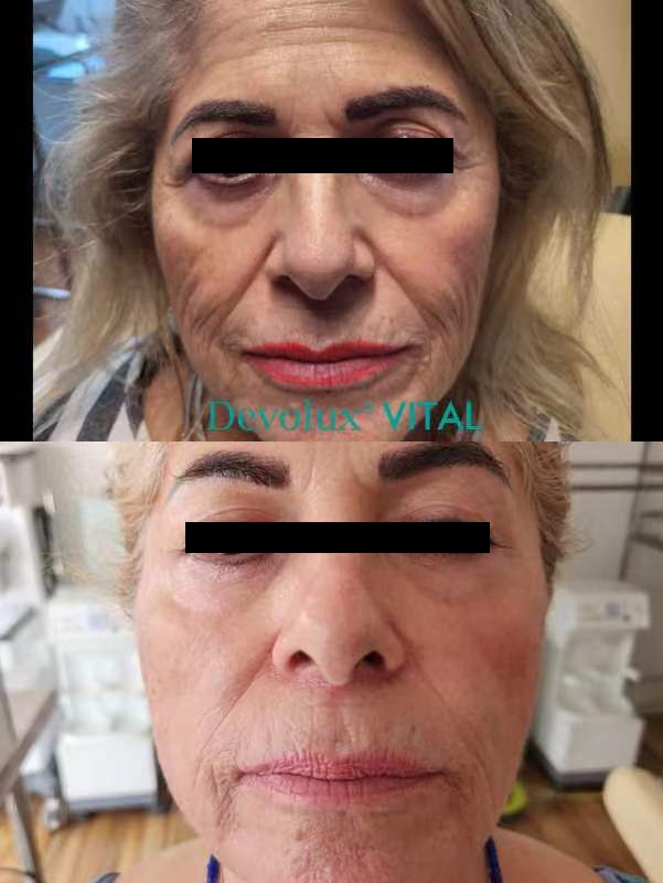 How long between PLLA treatments for dermal filler procedures