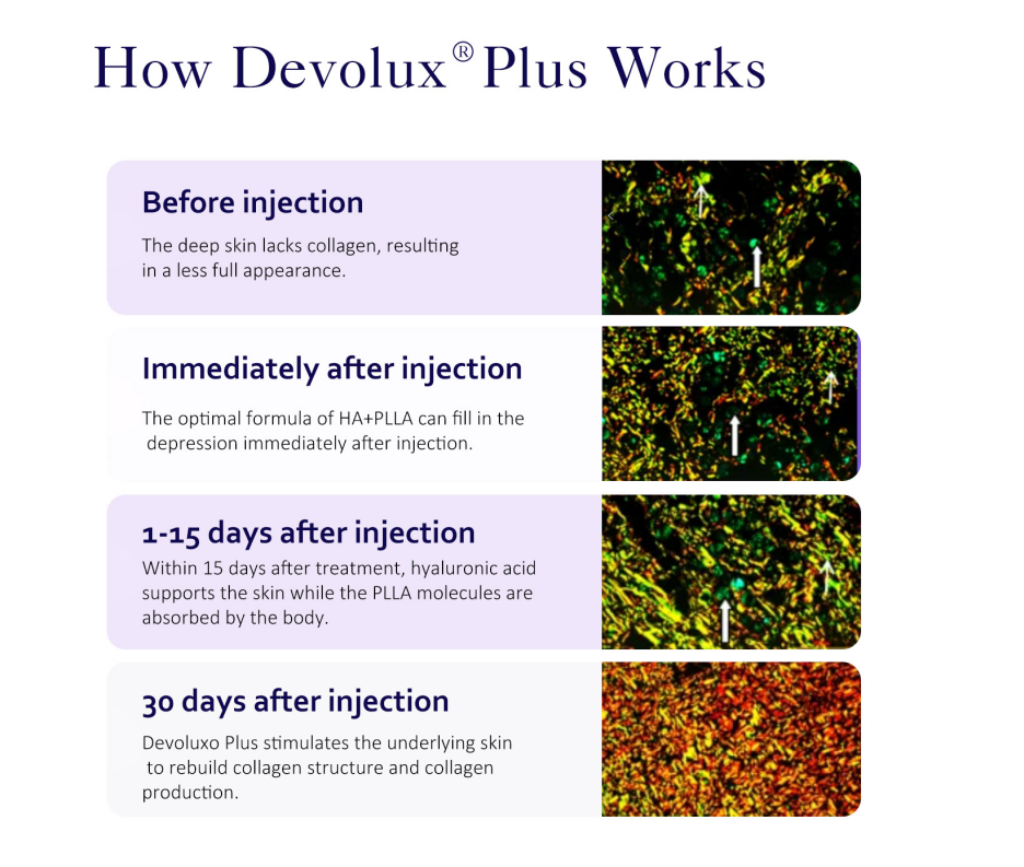 plla injection