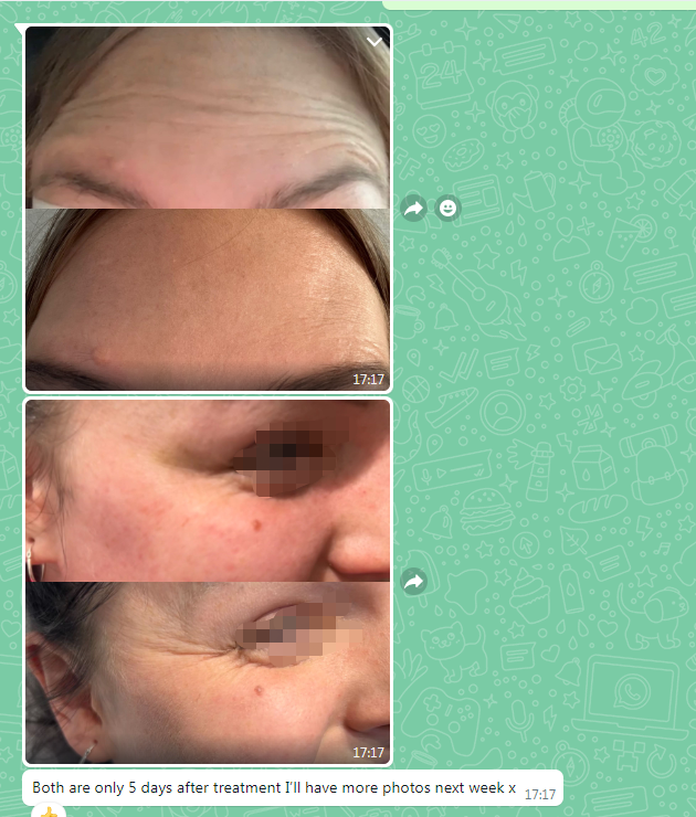 nabota botulinum toxin before and after