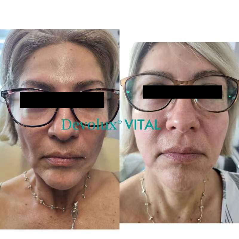 plla filler before and after