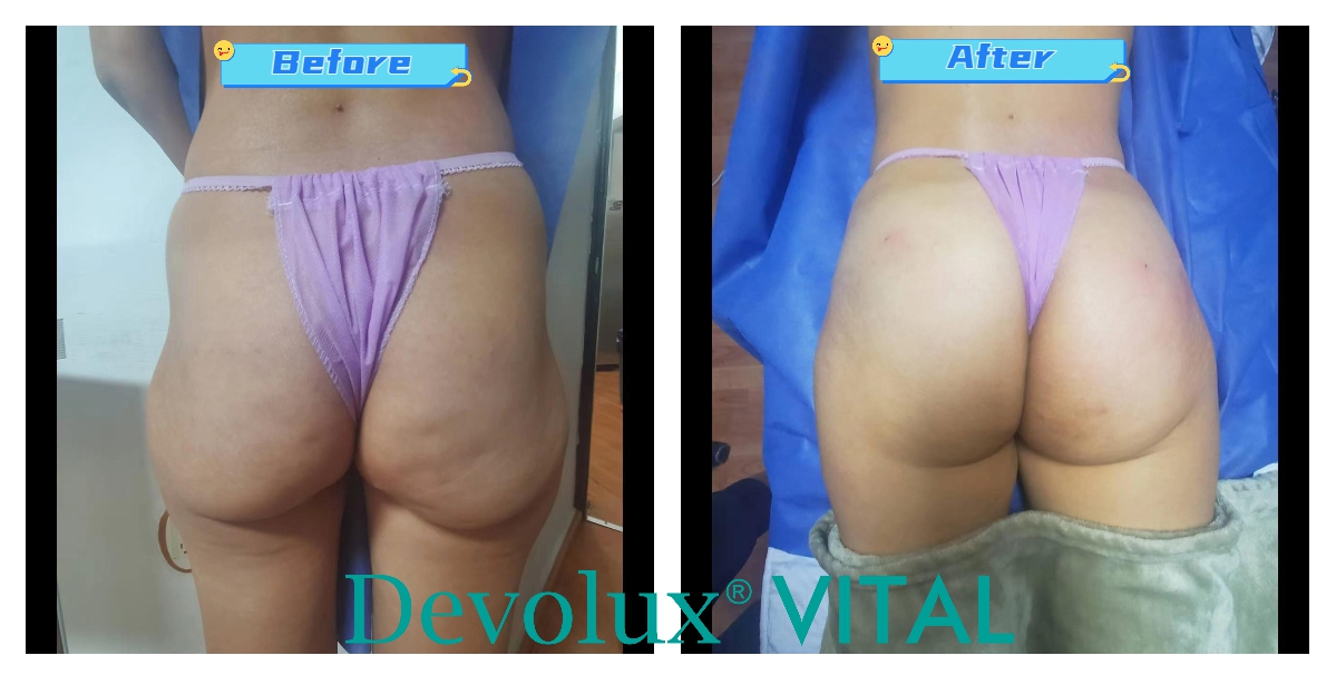 plla buttock injection before and after pictures