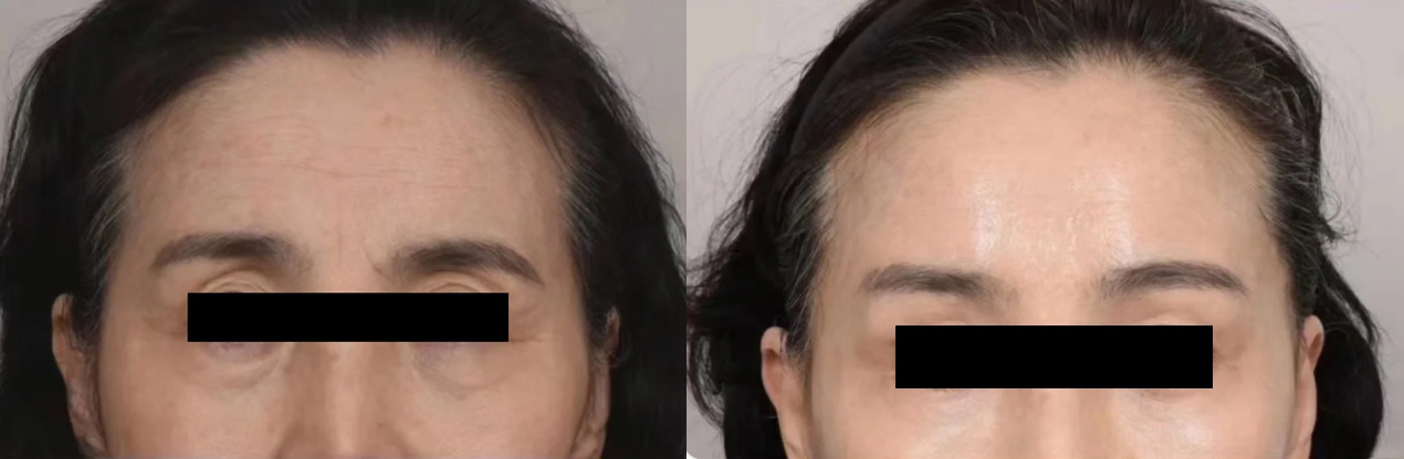 poly-l-lactic acid under eye filler before and after