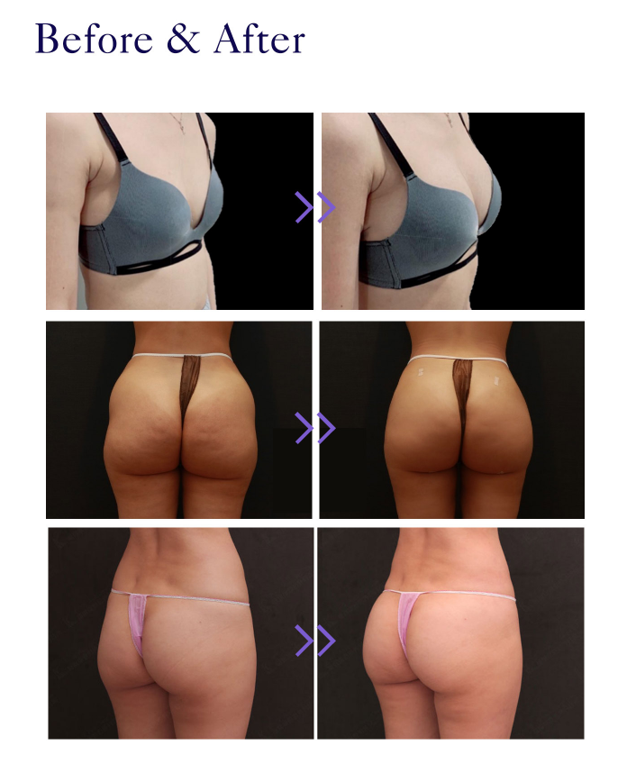 plla buttock injections before and after