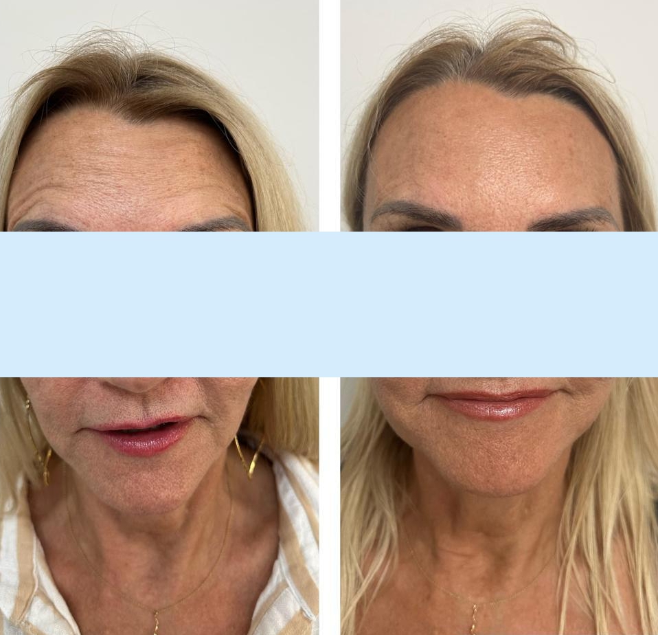 botulinum toxin before and after photo