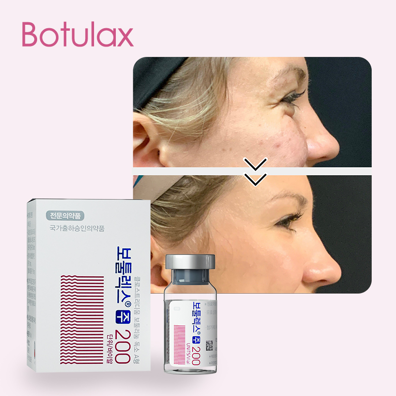 botulax before and after