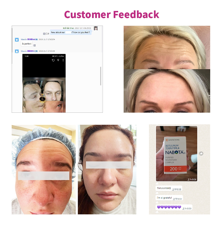 nabota botulinum toxin customer feedback