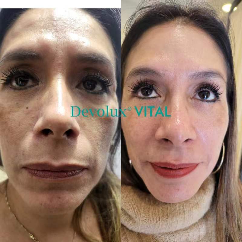 treating face with plla