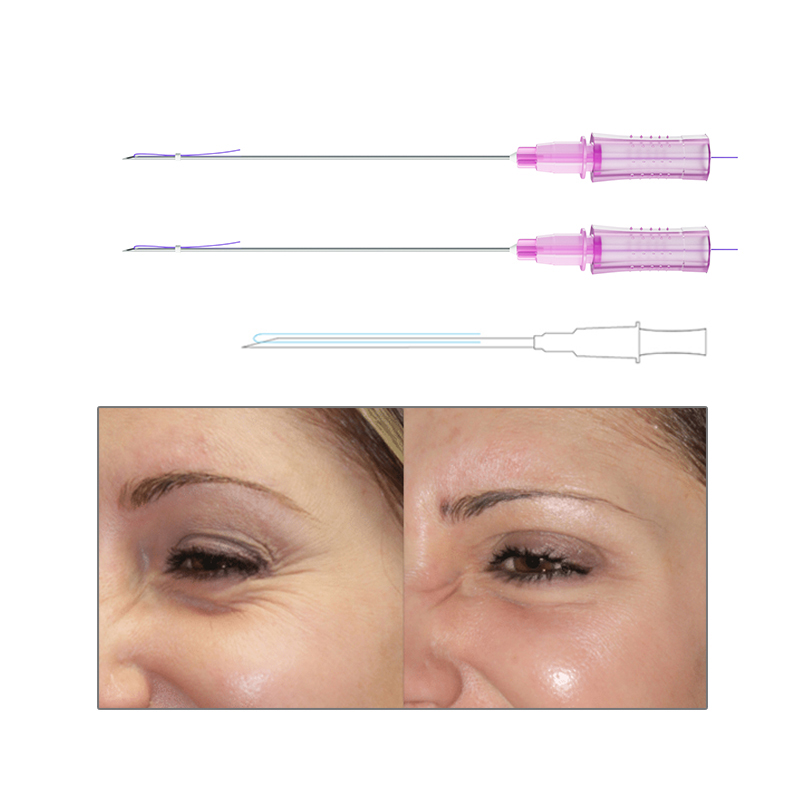 Magik Thread Before And After PDO Thread Lift For Eyes