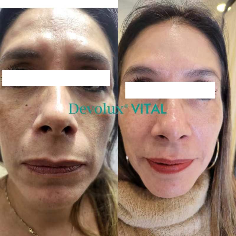 devolux vital plla filler before and after