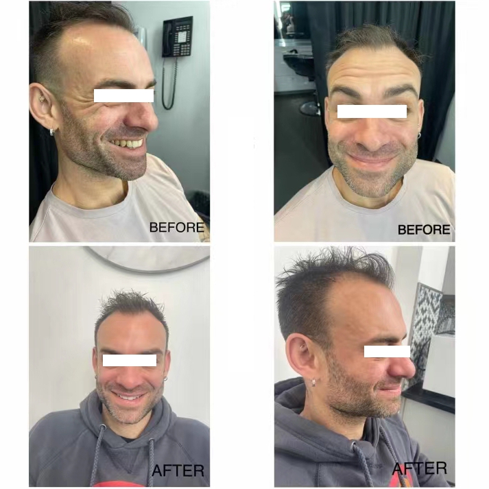 the effects after using botulinum toxin vial