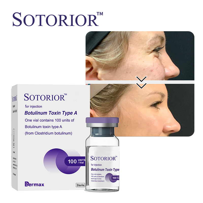 botulinum toxin for wrinkles