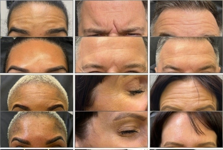 botulax injectable botulinum toxin before and after