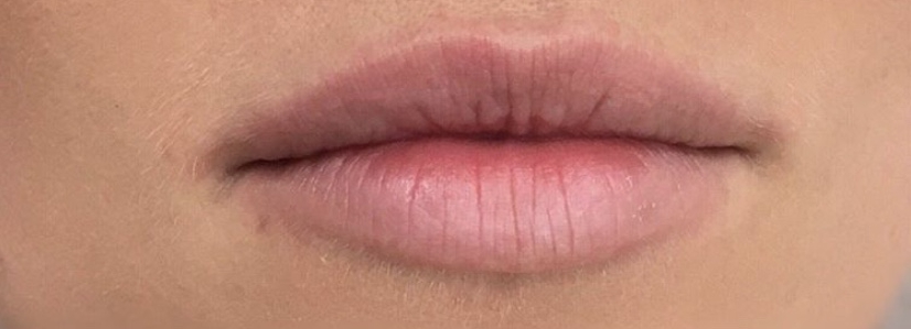 lip filler before 1ml