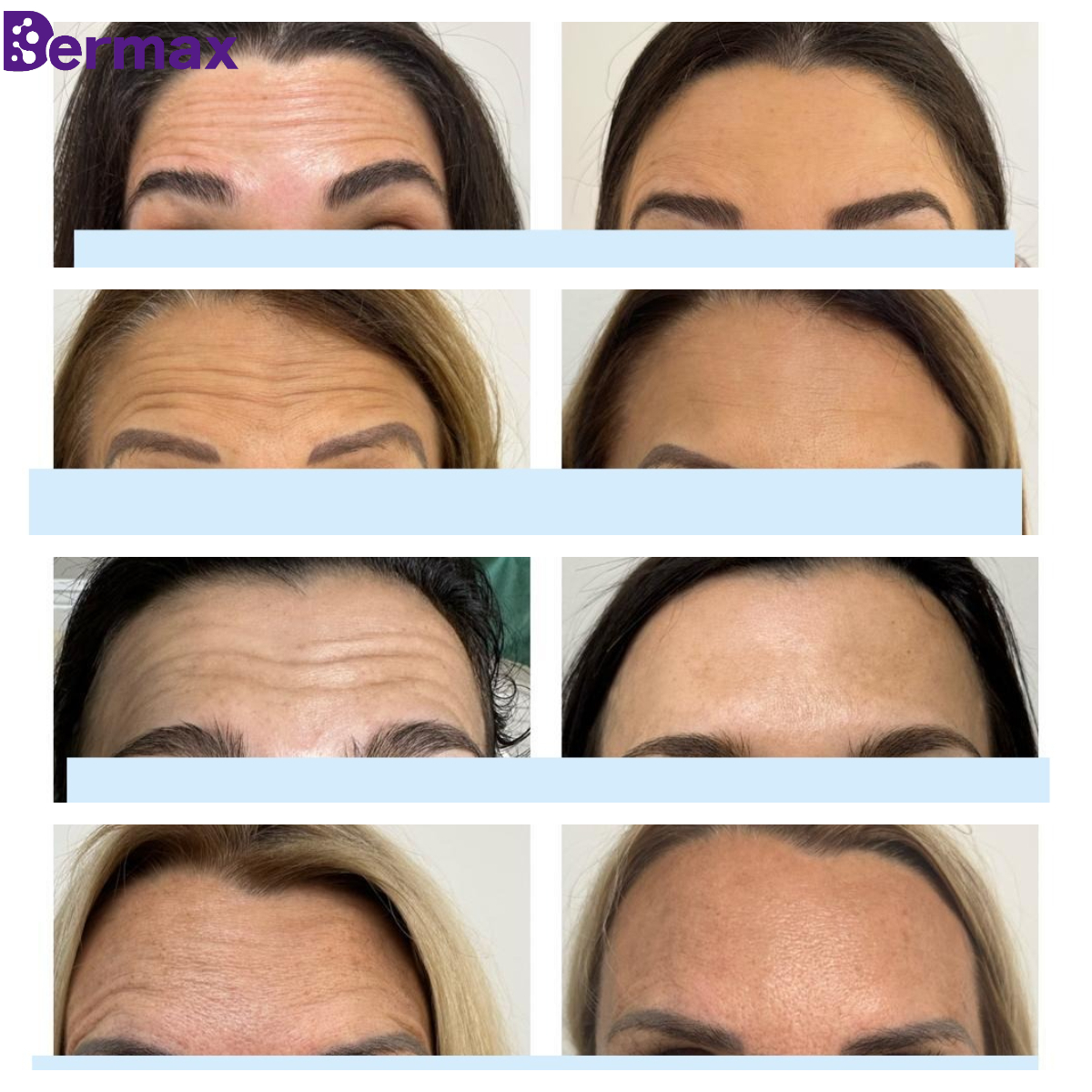 botulinum toxin for wrinkles