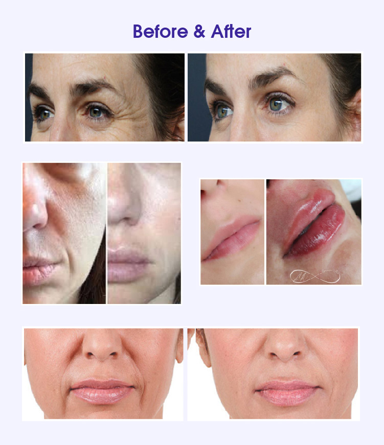 aqua secret dermal filler before and after