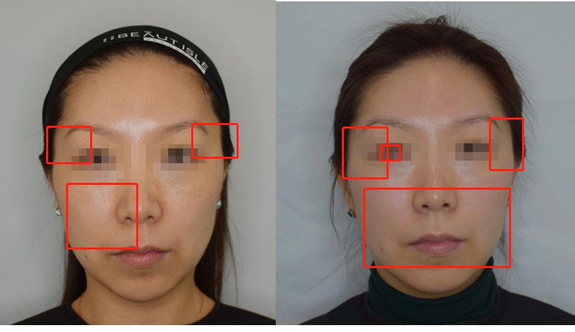 devolux plla before and after photos