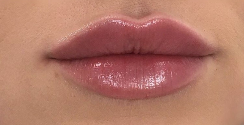 lip filler after 1ml