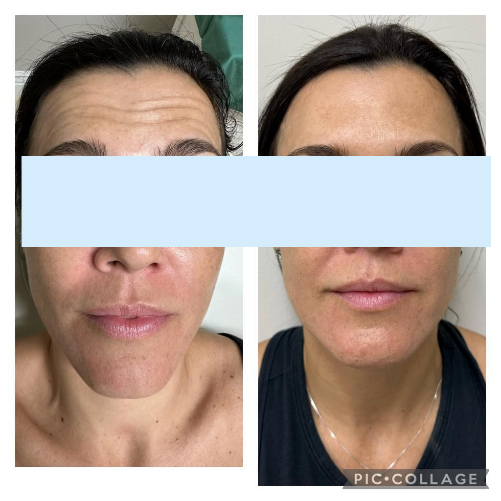 botulinum toxin type a treatment