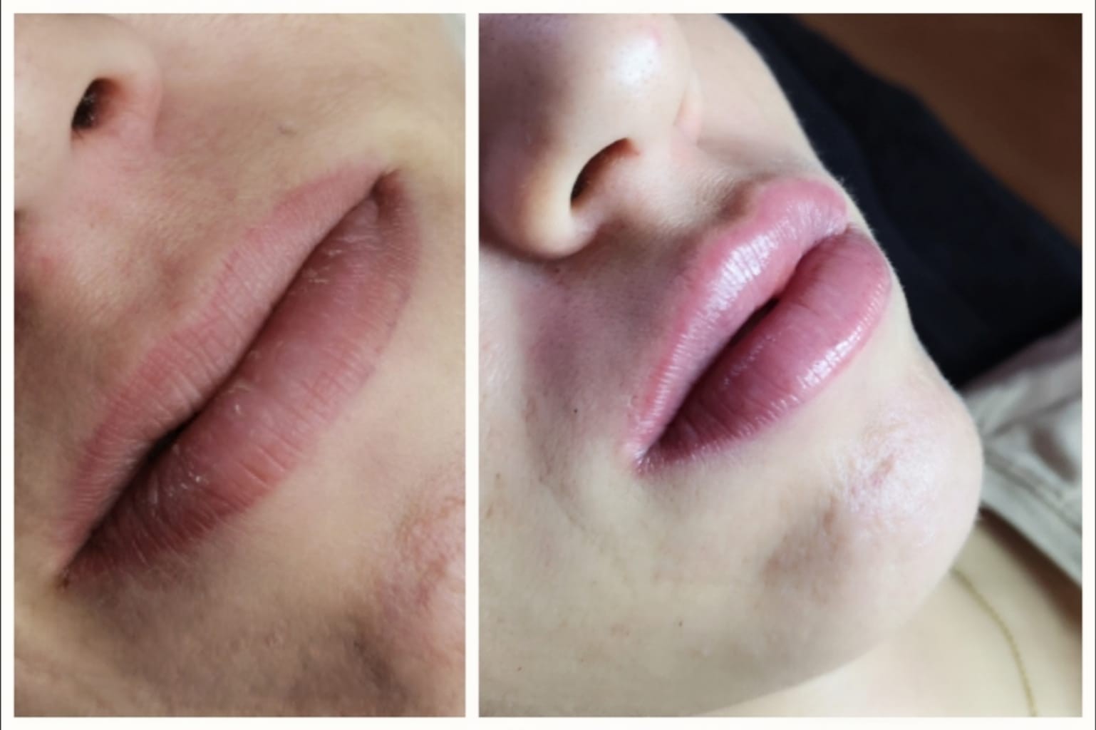 lip filler before and after