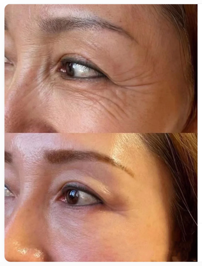 Magik Thread Before And After PDO Thread Lift For Eyes