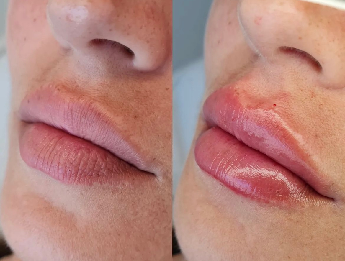 lip filler shapes before and after