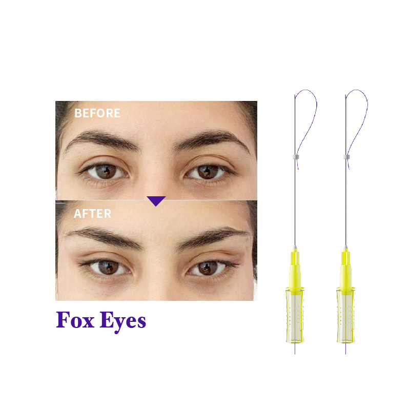 Magik Thread Before And After PDO Thread Lift For Eyes