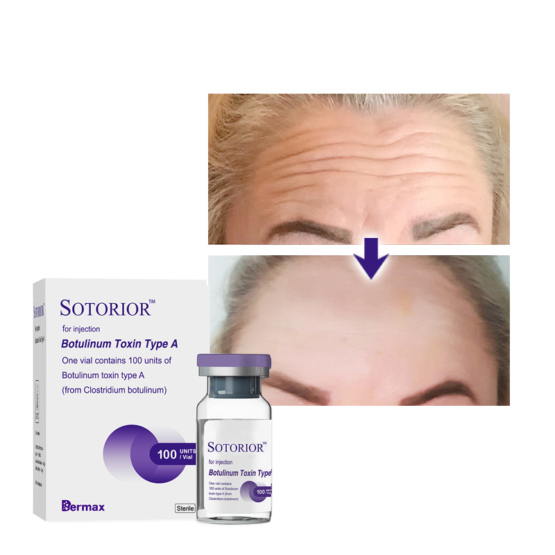 how many units of botulinum toxin for forehead