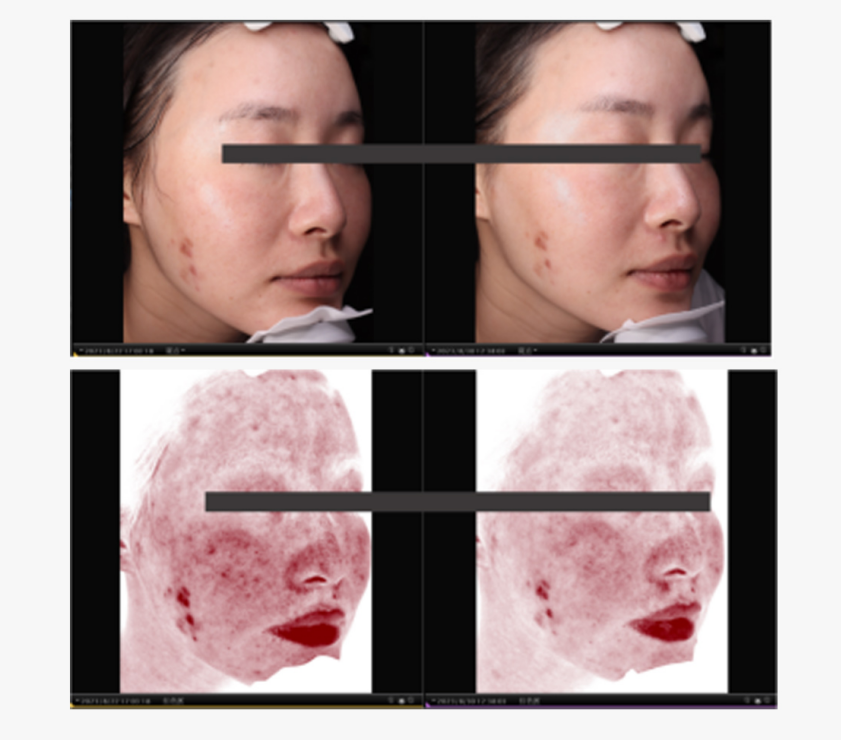 pdrn injection before and after