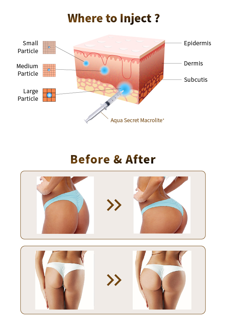 how to use dermal filler buttocks