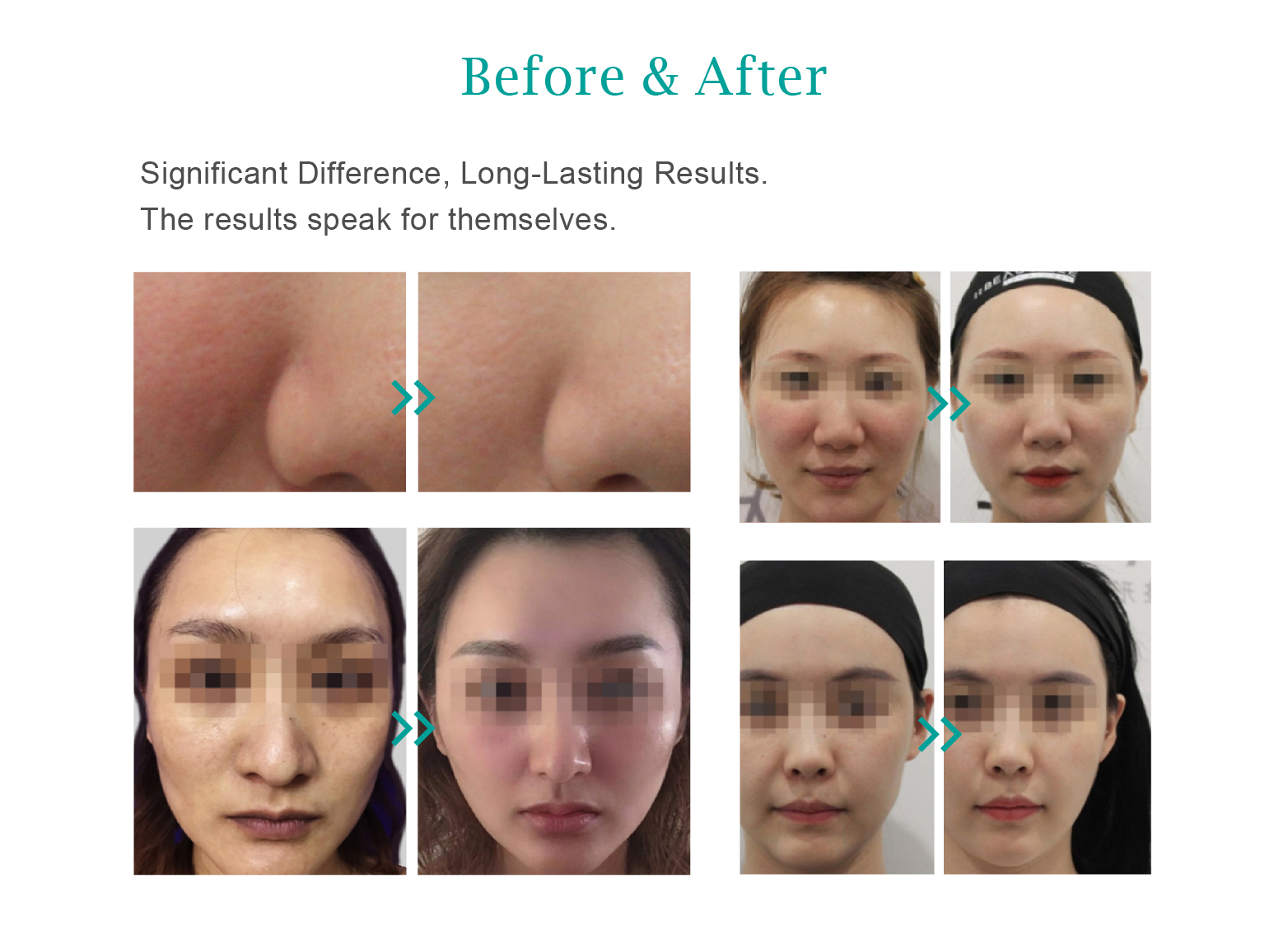 plla fillers before and after photos