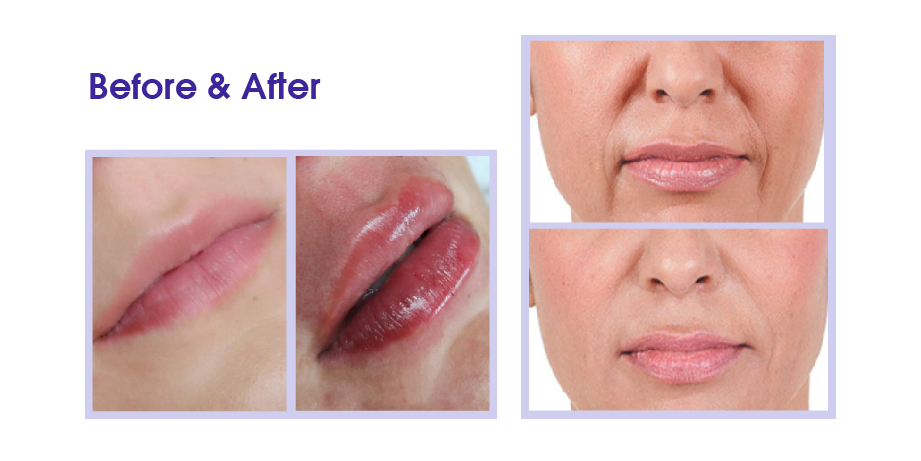 natural lip filler before and after photos