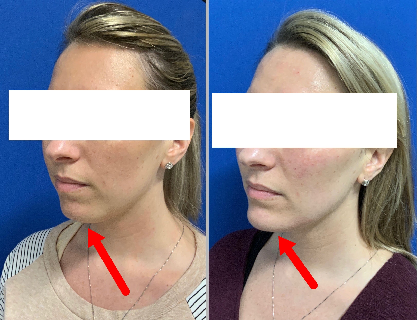 dermal filler chin augmentation before and after photos