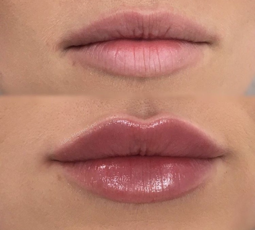 lip filler before and after