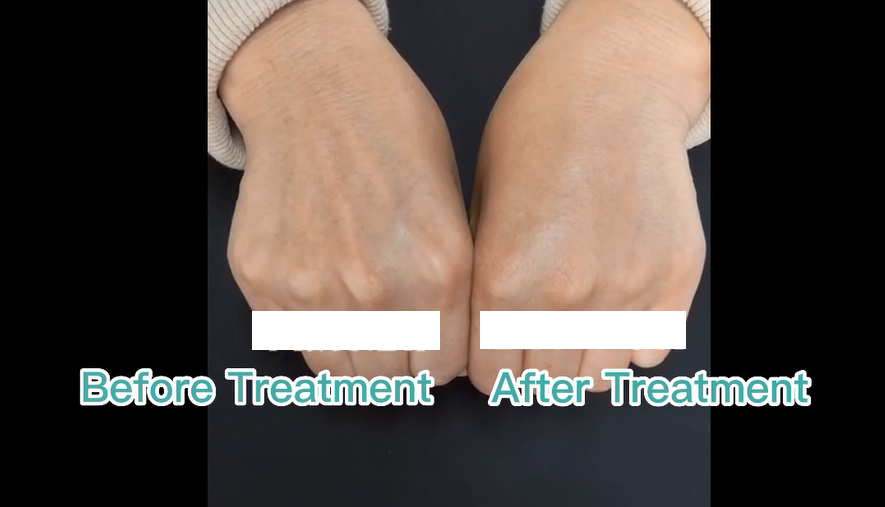 hands plla filler before and after