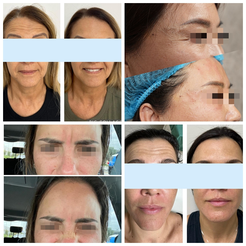 Before And After Of Innotox 50 Units Treatment