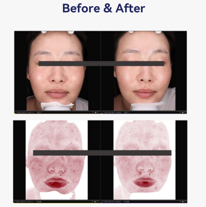 pdrn injection before and after