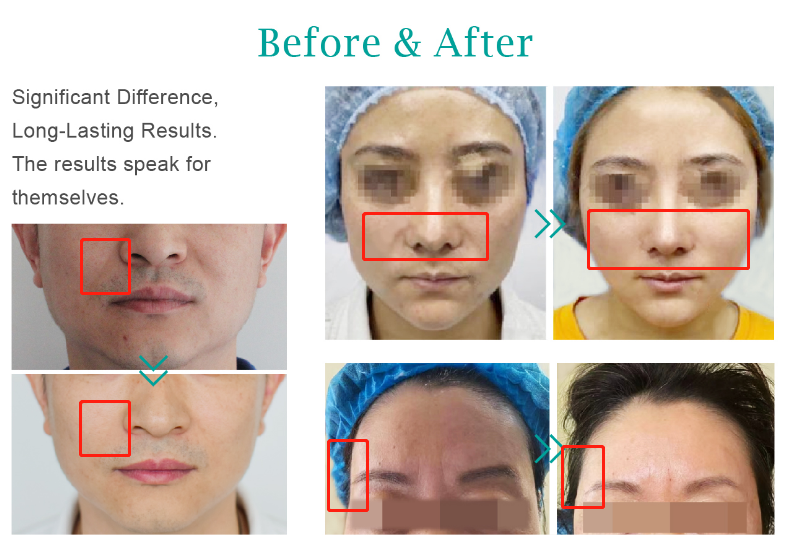 plla filler before and after