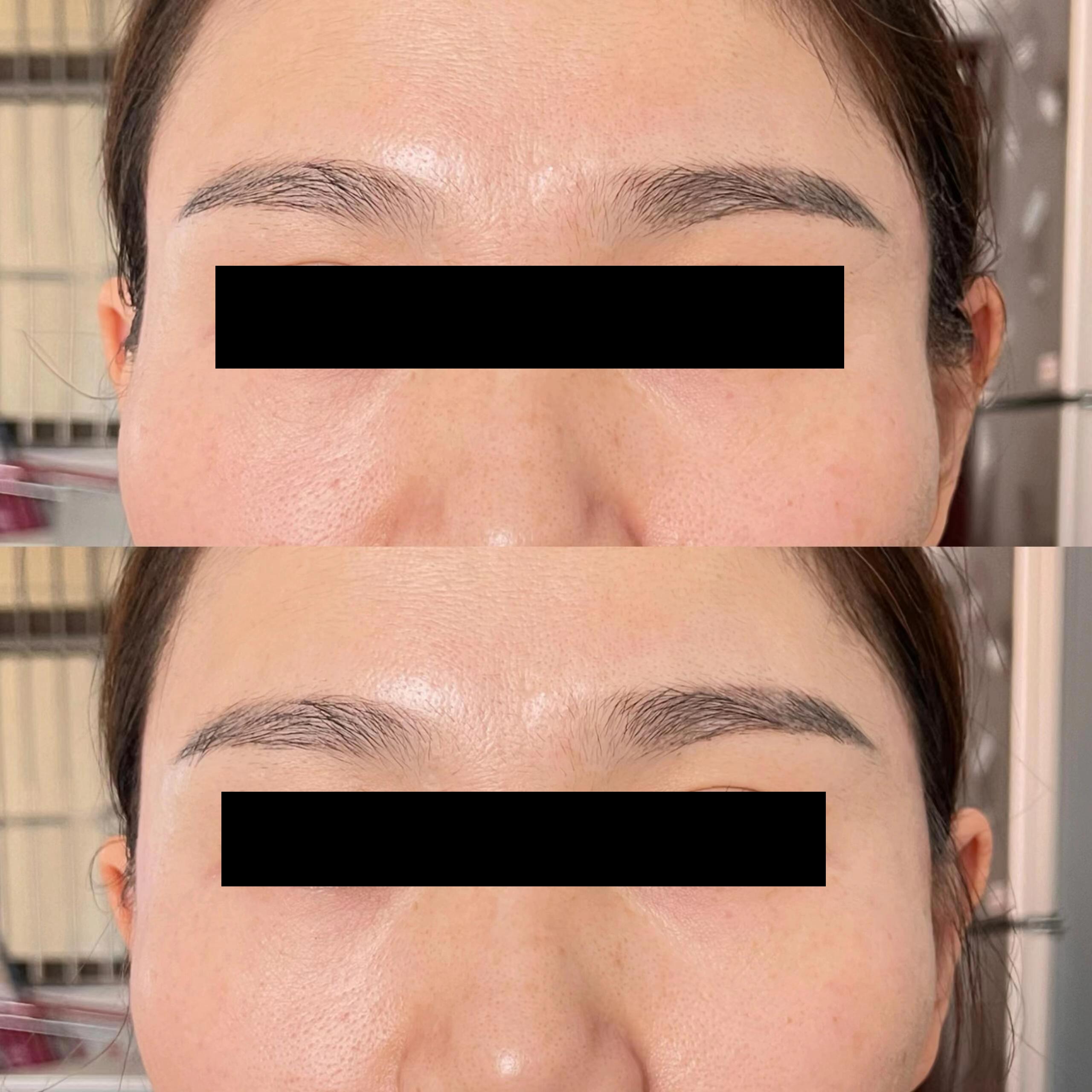 plla filler before and after