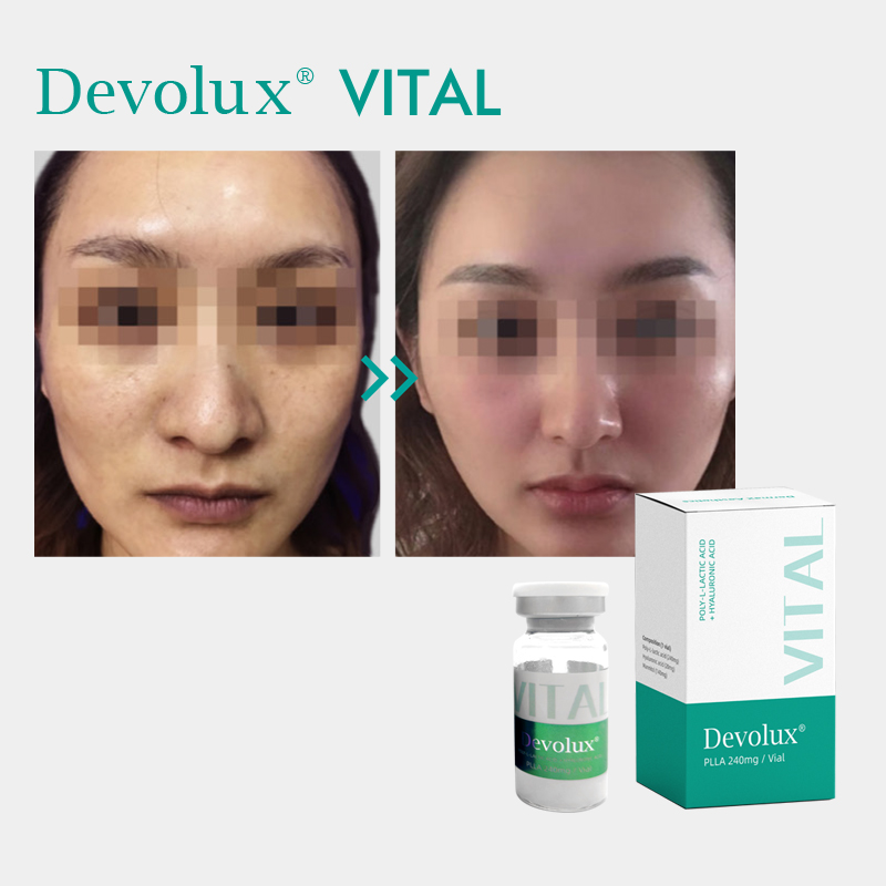 DEVOLUX® VITAL PLLA HA Dermal Filler Injection Instruction Manual
