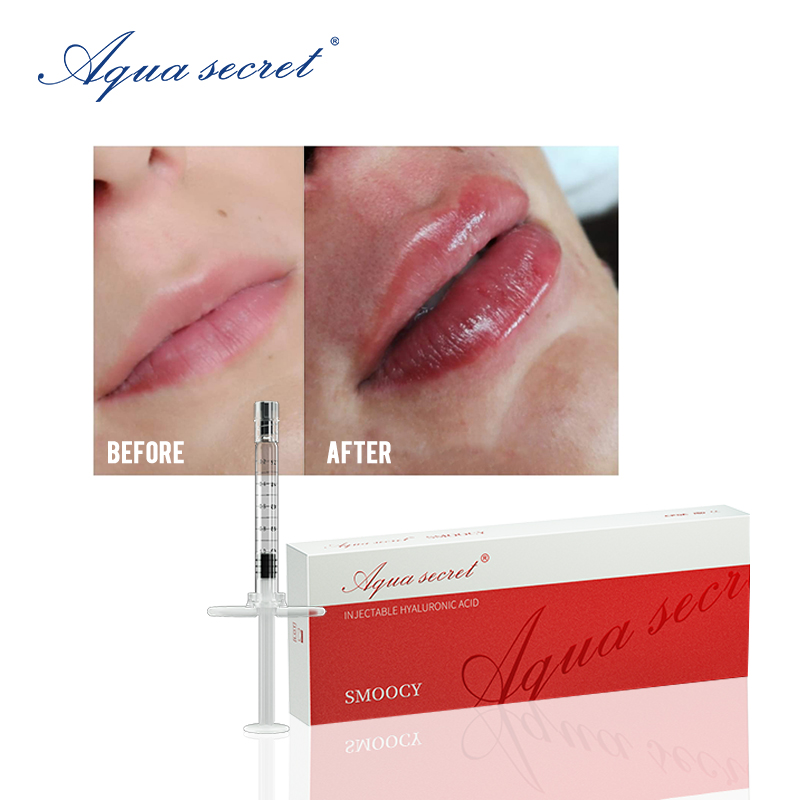 Lip Filler Before And After 1ml: Transform Your Look