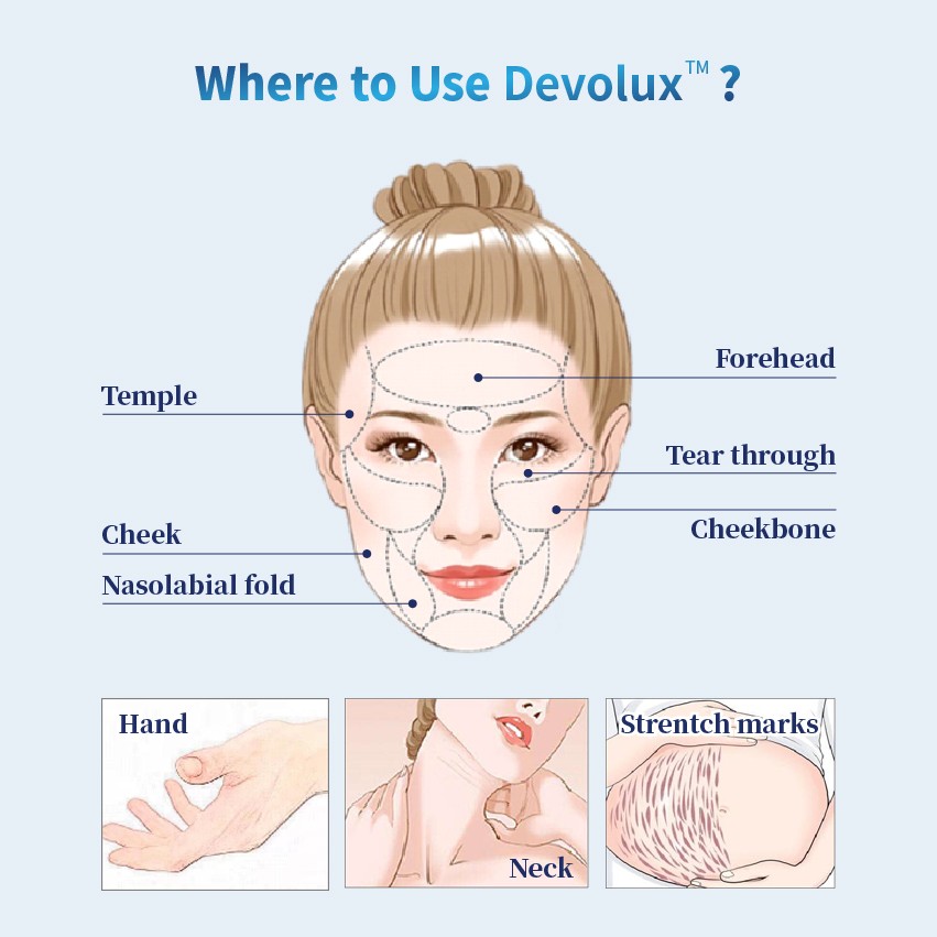 Poly L Lactic Acid Injection application - Dermax