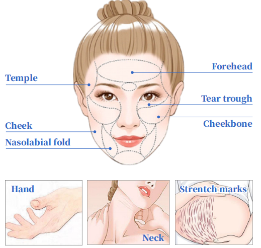 Nabota botulinum toxin type a Price