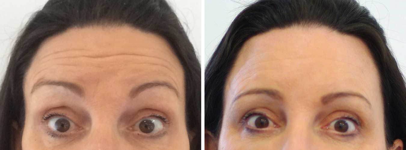 Dermal Filler & Anti-wrinkle Treatment Before & After Photos