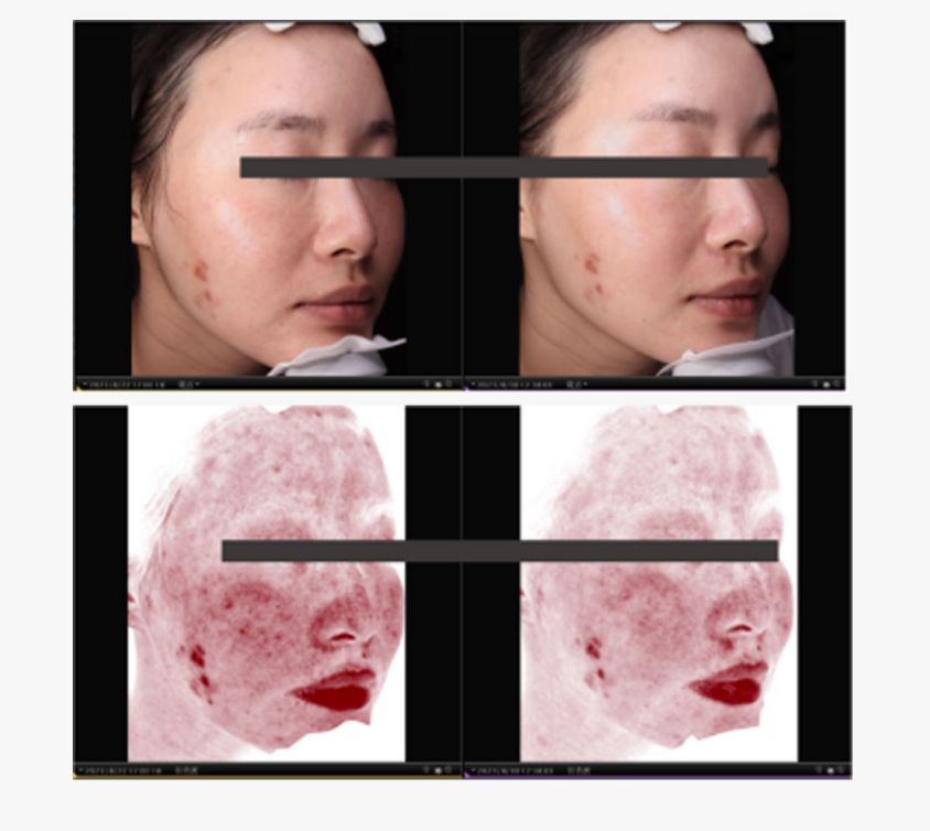 mesocel PDRN before after